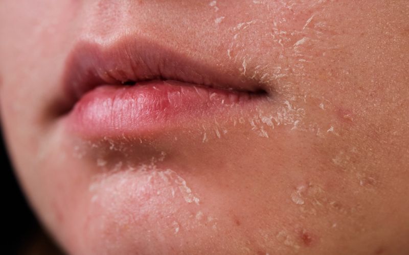 How to Fix Dry Flaky Skin on the Face