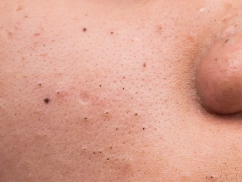 What Are Blackheads
